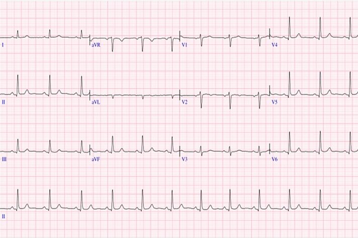https://www.mundoalbo.cl/wp-content/uploads/2025/06/electrocardiograma.jpg